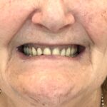 dental dentures before adelaide elite dental