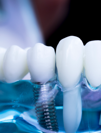 Follow up careRegular check-ups are important after your implant is complete. These appointments allow your dental implant dentist to monitor the implant site, check the condition of the prosthetic, and ensure everything is functioning as expected. Ongoing maintenance and good oral hygiene are key to supporting the longevity of your dental implant.