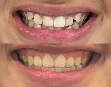 orthodontic-braces
