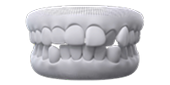 Mild to Moderate Relapse After Braces